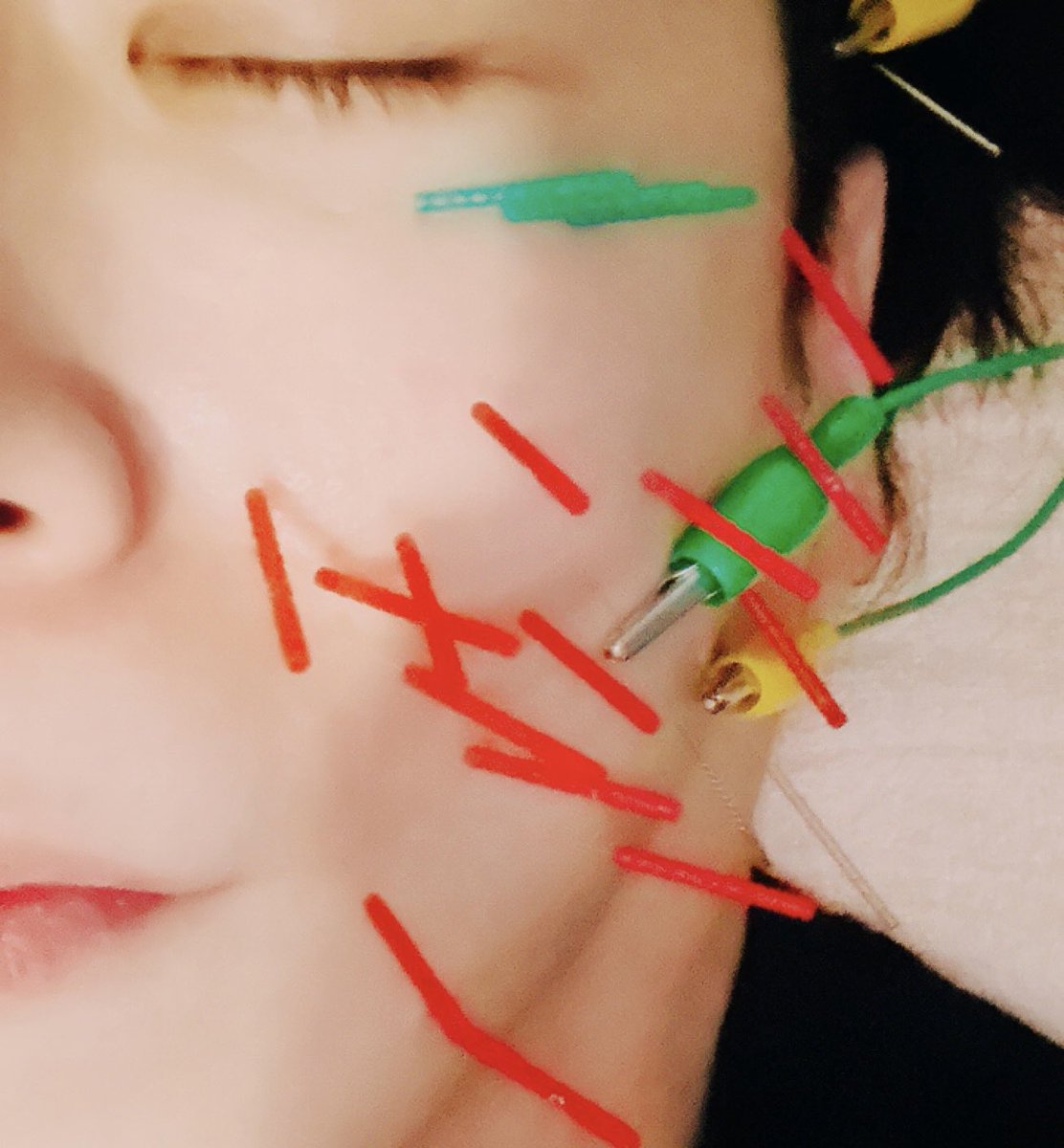 gonBullysDARTS's tweet photo. 定期メンテナンス
顔に鍼刺して電気流して生コラーゲン導入してきた。
鍼オススメ。 https://t.co/KUITOkVOID
