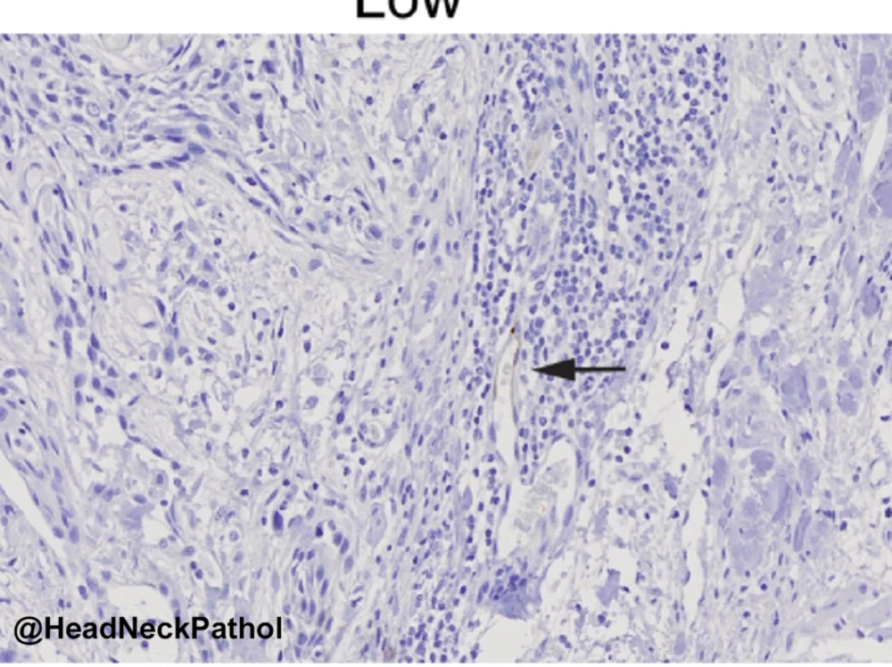 HeadandNeckPath's tweet photo. FoxP3+ Cells & PNAd+ Tumour-Associated High Endothelial Venules: Synergistic Prognostic Markers in Oral Tongue Squamous Cell Carcinoma
IA Abdulsalam, K Sellæg, FO Benebo, et al
https://t.co/UTeJuqsNnk
#HeadNeckPathol #HNPJ #HeadandNeckPath #Pathology #ENTPath #PathologyTweet https://t.co/vNIPRTNmgh