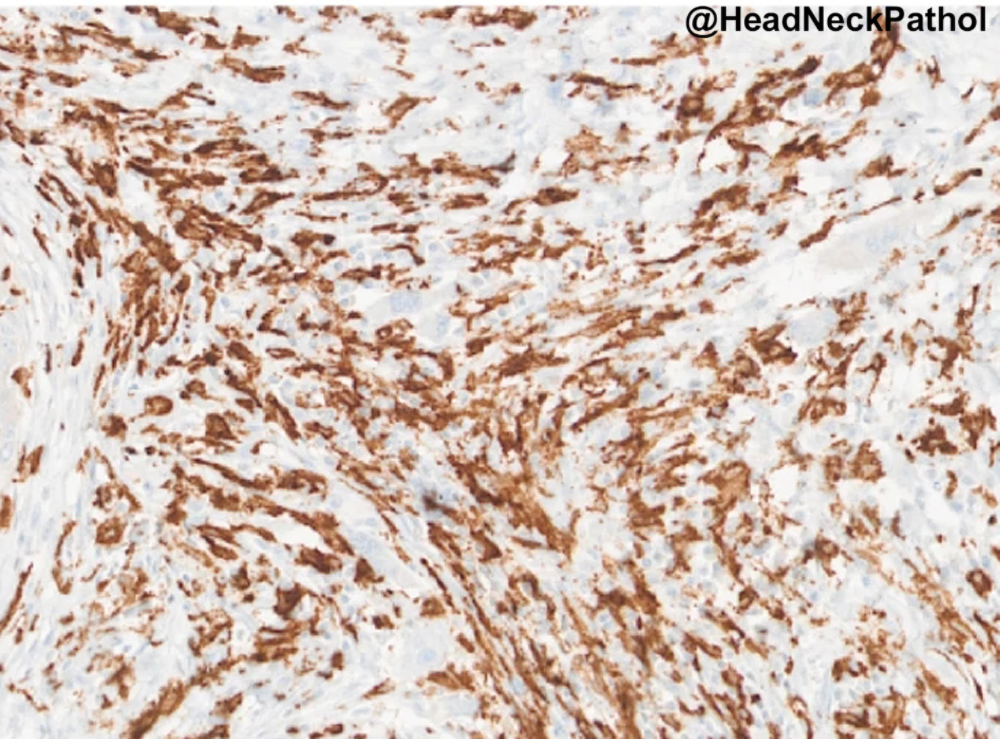 HeadandNeckPath's tweet photo. FoxP3+ Cells & PNAd+ Tumour-Associated High Endothelial Venules: Synergistic Prognostic Markers in Oral Tongue Squamous Cell Carcinoma
IA Abdulsalam, K Sellæg, FO Benebo, et al
https://t.co/UTeJuqsNnk
#HeadNeckPathol #HNPJ #HeadandNeckPath #Pathology #ENTPath #PathologyTweet https://t.co/vNIPRTNmgh