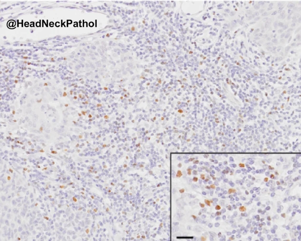 HeadNeckPathol's tweet photo. FoxP3+���Cells &amp; PNAd+ Tumour-Associated High Endothelial Venules: Synergistic Prognostic Markers in Oral Tongue Squamous Cell Carcinoma
IA Abdulsalam, K Sellæg, FO Benebo, et al
https://t.co/3ZJnQyJ2UU
#HeadNeckPathol #HNPJ #HeadandNeckPath #Pathology #ENTPath #PathologyTweet https://t.co/rih6cai3f2