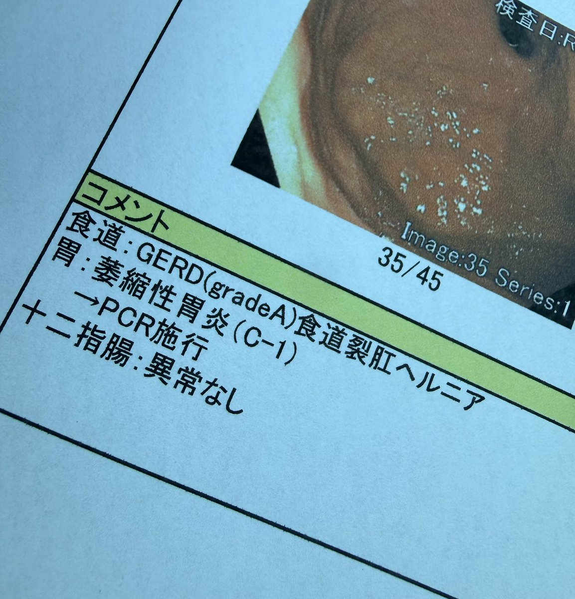 M_si0's tweet photo. 初✨胃カメラやってきました‼️

麻酔と慣らしの時点で「あれ…鼻の穴小さいな…口か…？」となりビビりちらかしていた俺ですが、先生の手腕によりなんとか口は回避できました😇
大型犬の唾液量でビックリしちゃった🫣

肝心のピロリは検査結果待ち〜PCRで潔く結果が出てくれ、俺は採血したくないんだ🫠 https://t.co/nMF7eeqatq