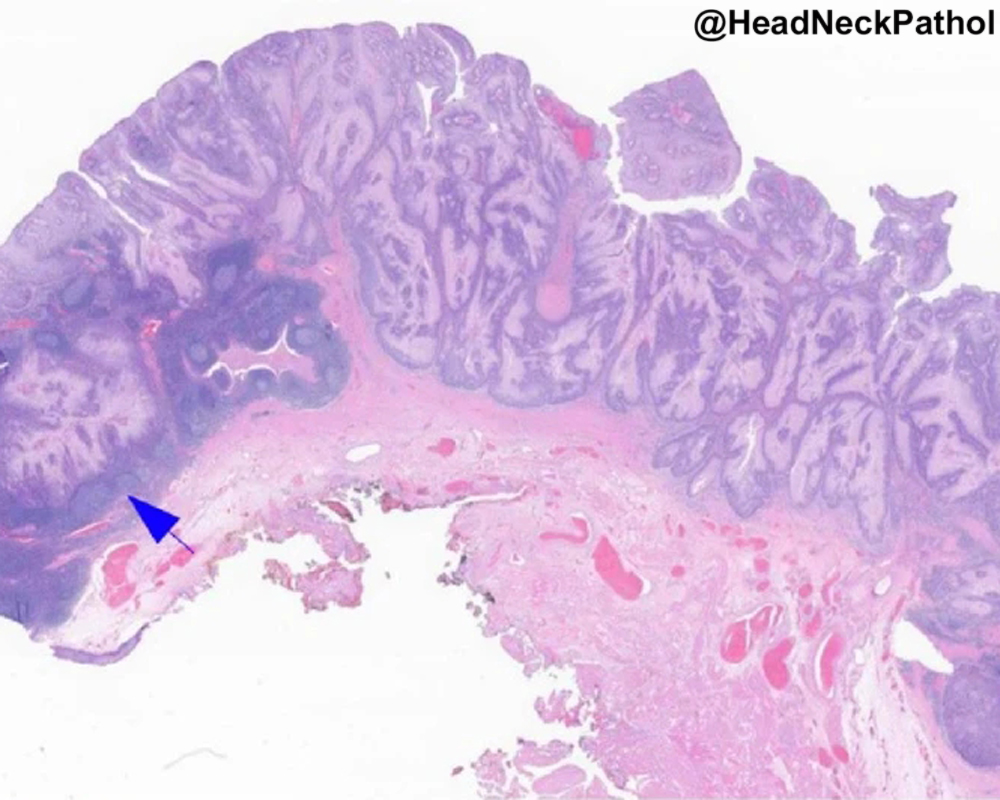 HeadNeckPathol tweet picture