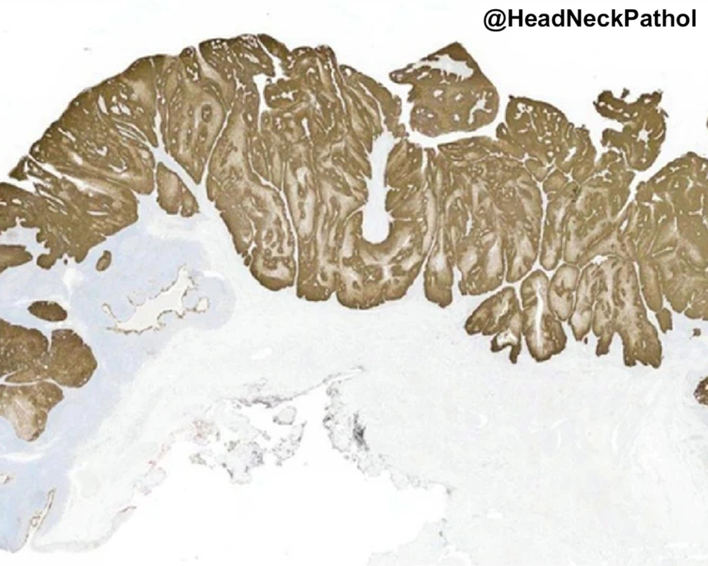 HeadNeckPathol tweet picture