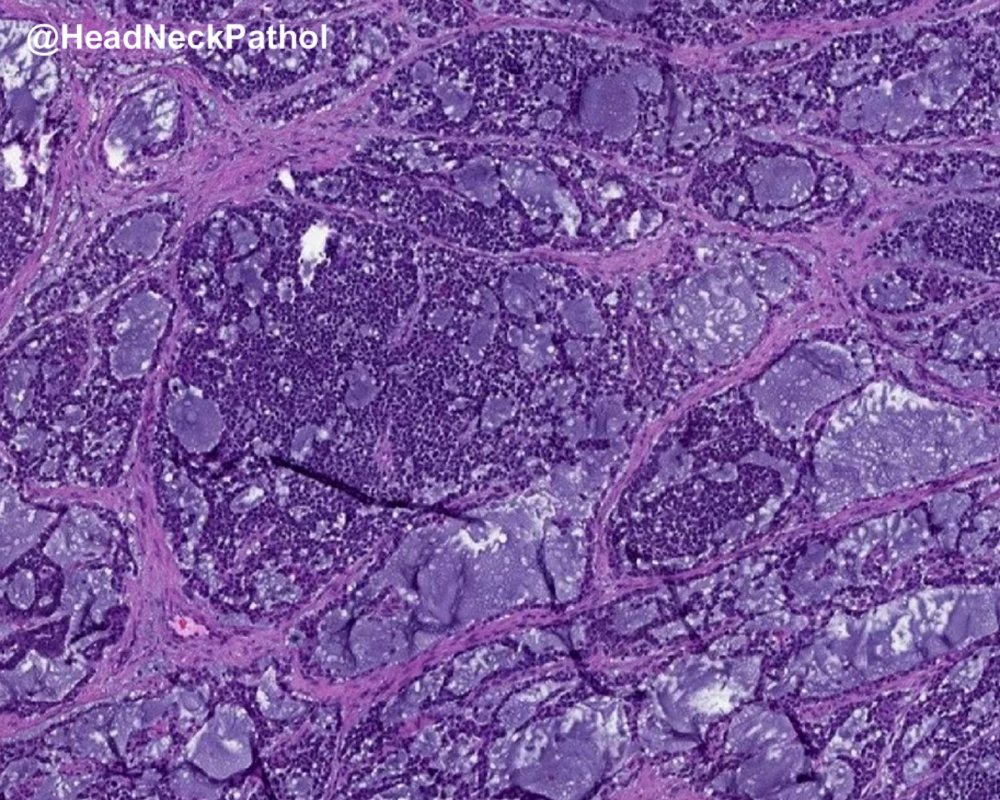 HeadNeckPathol tweet picture