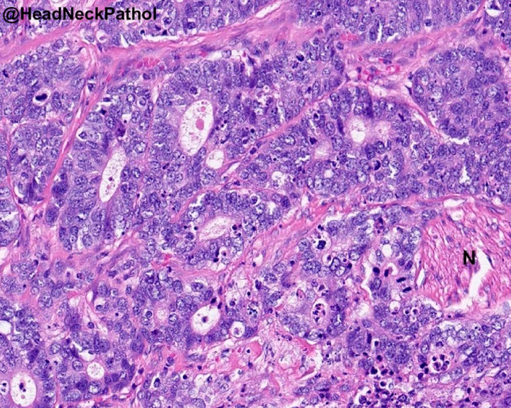 HeadNeckPathol tweet picture