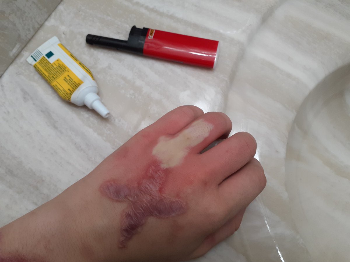 YourLocalGirl33's tweet photo. New burn i lost my engagement ring this is my punishment i hope its scars big enough that i cant move the finger right https://t.co/kcEq0pojBf
