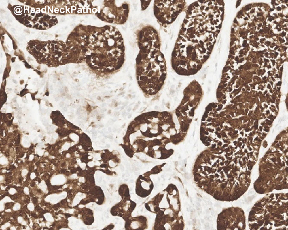 HeadandNeckPath's tweet photo. Expanding the Histologic Spectrum of HPV-Associated Oropharyngeal Carcinoma: A Study of 379 Cases Focusing on Classification, Histologic Features, &amp; their Prognostic Significance
https://t.co/53B8fWkS2c
#HeadNeckPathol #HNPJ #HeadandNeckPath #Pathology #ENTPath #PathologyTweet https://t.co/I17wC6PaTZ