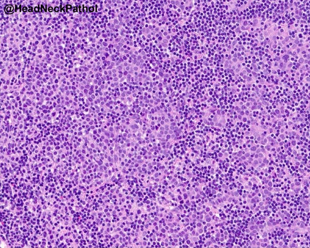 HeadandNeckPath's tweet photo. Expanding the Histologic Spectrum of HPV-Associated Oropharyngeal Carcinoma: A Study of 379 Cases Focusing on Classification, Histologic Features, &amp; their Prognostic Significance
https://t.co/53B8fWkS2c
#HeadNeckPathol #HNPJ #HeadandNeckPath #Pathology #ENTPath #PathologyTweet https://t.co/I17wC6PaTZ