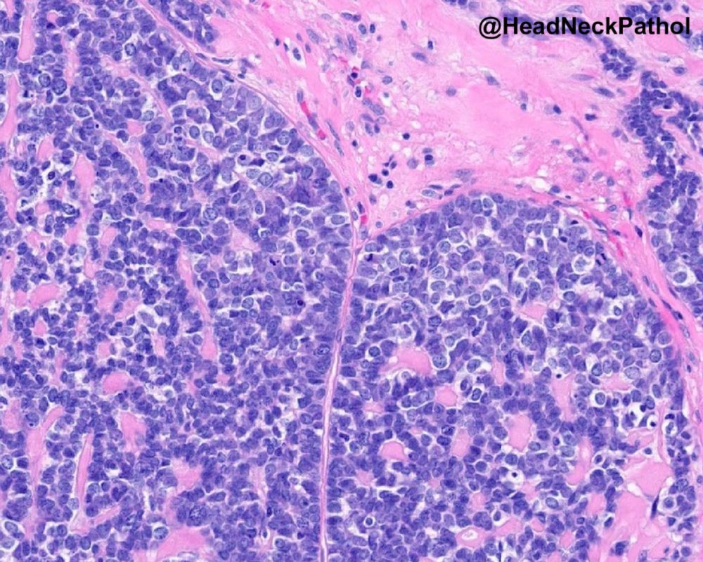 HeadandNeckPath's tweet photo. Expanding the Histologic Spectrum of HPV-Associated Oropharyngeal Carcinoma: A Study of 379 Cases Focusing on Classification, Histologic Features, &amp; their Prognostic Significance
https://t.co/53B8fWkS2c
#HeadNeckPathol #HNPJ #HeadandNeckPath #Pathology #ENTPath #PathologyTweet https://t.co/I17wC6PaTZ