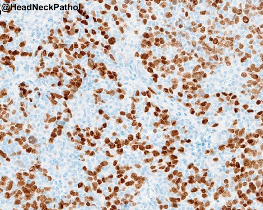 HeadandNeckPath's tweet photo. Expanding the Histologic Spectrum of HPV-Associated Oropharyngeal Carcinoma: A Study of 379 Cases Focusing on Classification, Histologic Features, &amp; their Prognostic Significance
https://t.co/53B8fWkS2c
#HeadNeckPathol #HNPJ #HeadandNeckPath #Pathology #ENTPath #PathologyTweet https://t.co/I17wC6PaTZ