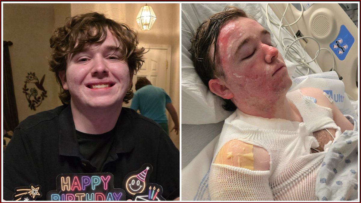 XtexasgirlX's tweet photo. HORRIFYING.

A 20-year-old shift manager at a Yuba City McDonald’s clocked out after his shift on May 30 when his 23-year-old coworker allegedly threw hot cooking oil all over him. 

Jacob Smith suffered second-degree burns over 22% of his body. Face, neck, hands, arm, shoulder, back. 

He’s still in the ICU at UC Davis fighting excruciating pain and facing surgery. 

One minute you’re flipping burgers with a coworker. The next you’re in a burn unit wondering why he did this to you. 

This wasn’t some freak accident. It was a deliberate attack at a job millions of young people trust to be safe. 

Jacob was building a life, recent grad, planning a wedding. Now his family is praying through skin grafts and lost wages. 

How does this even happen in a fast-food kitchen? 

Prayers for Jacob’s recovery and real justice.  🙏