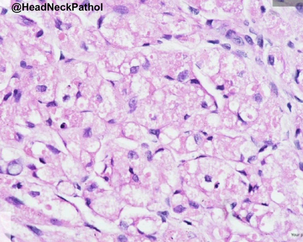 HeadandNeckPath's tweet photo. Cytoplasmic Granules in Granular Cell Tumor &amp; Congenital Epulis: A Histochemical &amp; Immunohistochemical Note
Aadithya Urs, Revathi Krishna, Lama Malik, J Augustine &amp; Priya Kumar 
https://t.co/VxfOIfVTLR
#HeadNeckPathol #HNPJ #HeadandNeckPath #Pathology #ENTPath #PathologyTweet https://t.co/kZ8pHILM61