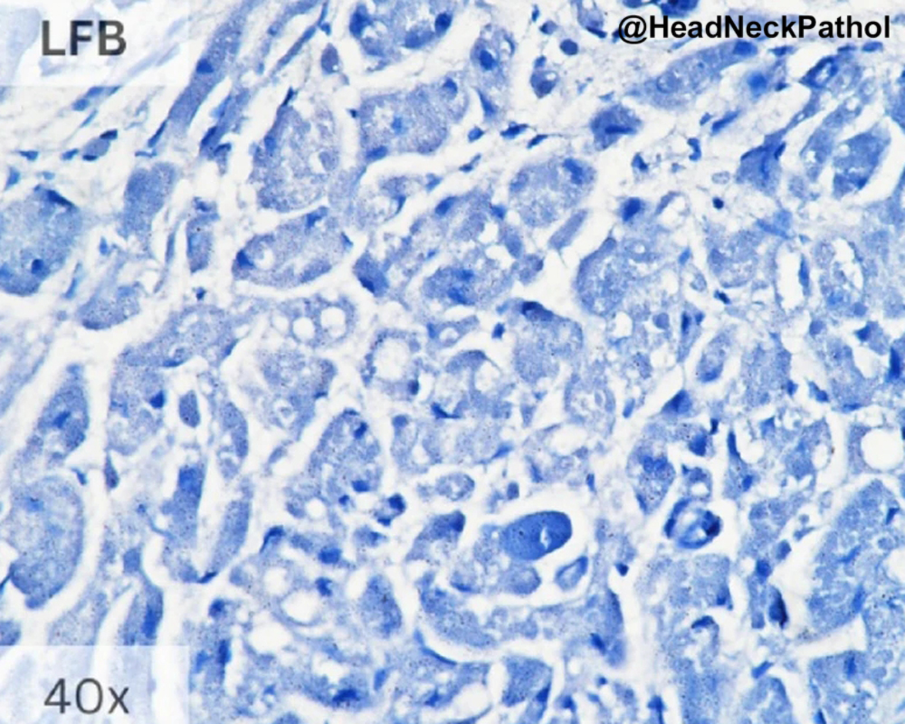 HeadandNeckPath's tweet photo. Cytoplasmic Granules in Granular Cell Tumor &amp; Congenital Epulis: A Histochemical &amp; Immunohistochemical Note
Aadithya Urs, Revathi Krishna, Lama Malik, J Augustine &amp; Priya Kumar 
https://t.co/VxfOIfVTLR
#HeadNeckPathol #HNPJ #HeadandNeckPath #Pathology #ENTPath #PathologyTweet https://t.co/kZ8pHILM61