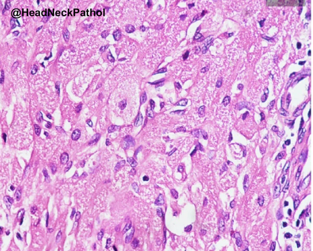 HeadNeckPathol's tweet photo. Cytoplasmic Granules in Granular Cell Tumor &amp; Congenital Epulis: A Histochemical &amp; Immunohistochemical Note
Aadithya Urs, Revathi Krishna, Lama Malik, J Augustine &amp; Priya Kumar
https://t.co/58bdqs3w6W
#HeadNeckPathol #HNPJ #HeadandNeckPath #Pathology #ENTPath #PathologyTweet https://t.co/MgMbKuiC2C