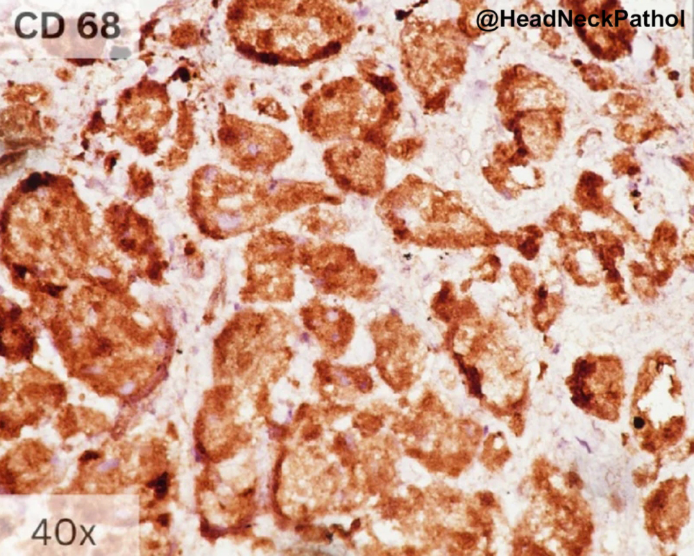 HeadNeckPathol's tweet photo. Cytoplasmic Granules in Granular Cell Tumor &amp; Congenital Epulis: A Histochemical &amp; Immunohistochemical Note
Aadithya Urs, Revathi Krishna, Lama Malik, J Augustine &amp; Priya Kumar
https://t.co/58bdqs3w6W
#HeadNeckPathol #HNPJ #HeadandNeckPath #Pathology #ENTPath #PathologyTweet https://t.co/MgMbKuiC2C
