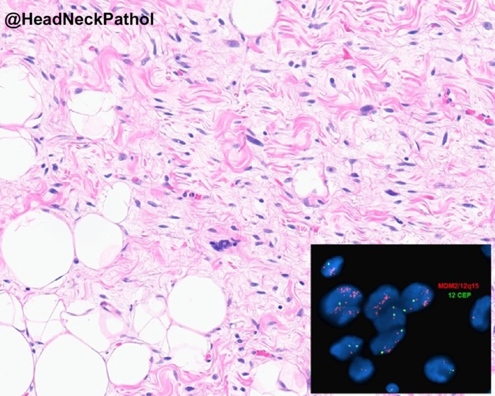 HeadNeckPathol's tweet photo. Laryngopharyngeal Liposarcoma: A (Somewhat Docile) Wolf in Sheep’s Clothing
Kevin Mijares, Diana Bell, Karen Schoedel, Jason Wasserman, Bibianna Purgina &amp; Raja R. Seethala 
https://t.co/SrOlKY6v6r
#HeadNeckPathol #HNPJ #HeadandNeckPath #Pathology #ENTPath #PathologyTweet https://t.co/MIXfrqfWQC