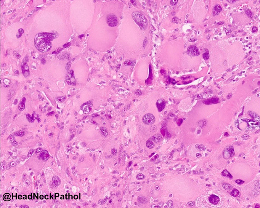HeadNeckPathol's tweet photo. Laryngopharyngeal Liposarcoma: A (Somewhat Docile) Wolf in Sheep’s Clothing
Kevin Mijares, Diana Bell, Karen Schoedel, Jason Wasserman, Bibianna Purgina &amp; Raja R. Seethala 
https://t.co/SrOlKY6v6r
#HeadNeckPathol #HNPJ #HeadandNeckPath #Pathology #ENTPath #PathologyTweet https://t.co/MIXfrqfWQC