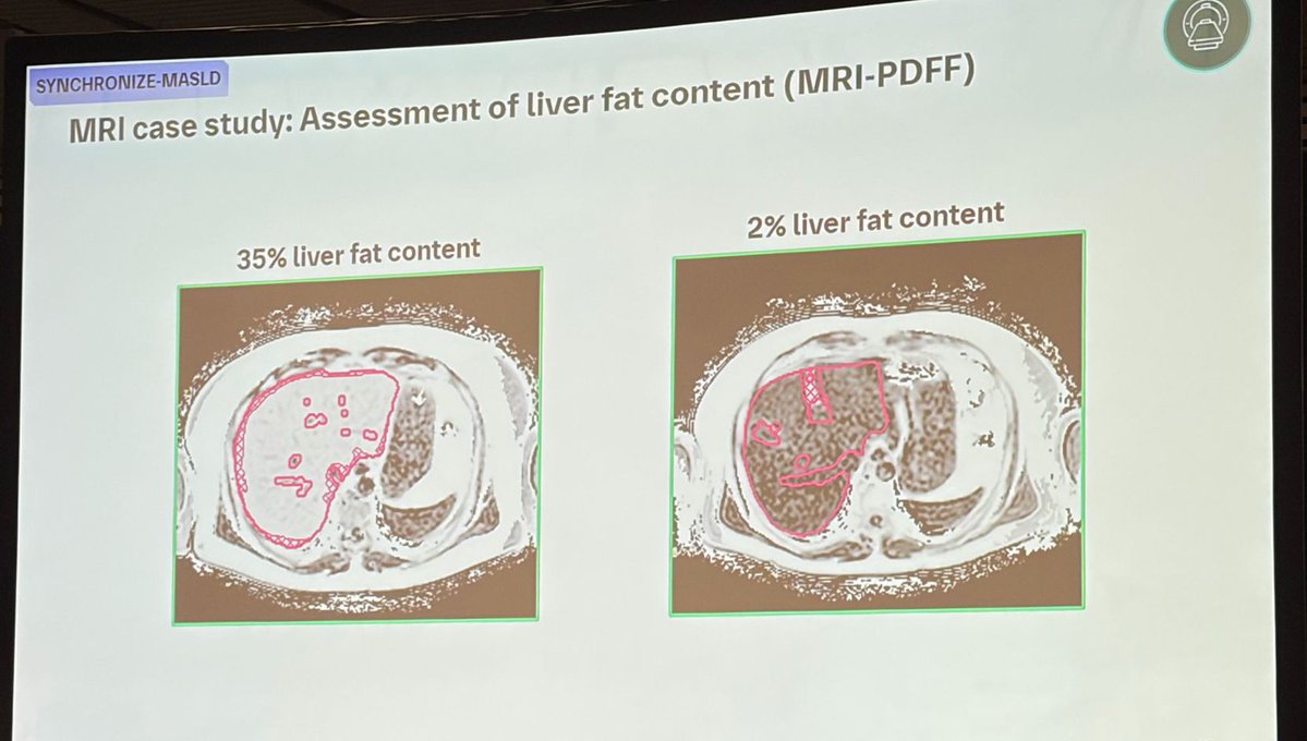 The new class of GLP-1 + glucagon drugs has, once again, shown that it can  obliterate liver fat. Fatty liver disease might be a thing of the past when  these things hit