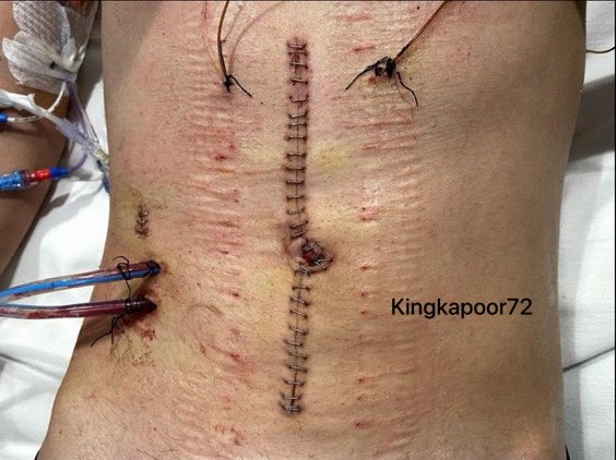 kingkapoor72's tweet photo. 🇦🇺 Australia faced a similar kirpan stabbing, just like the Nowak murder in the UK.

In May 2021, a 14-year-old Sikh stabbed 16-year-old Jake Arakelian with a sharp kirpan in a NSW school fight, causing serious back, stomach, and organ injuries. NSW banned kirpans in schools temporarily, then reversed it after Sikh pressure.