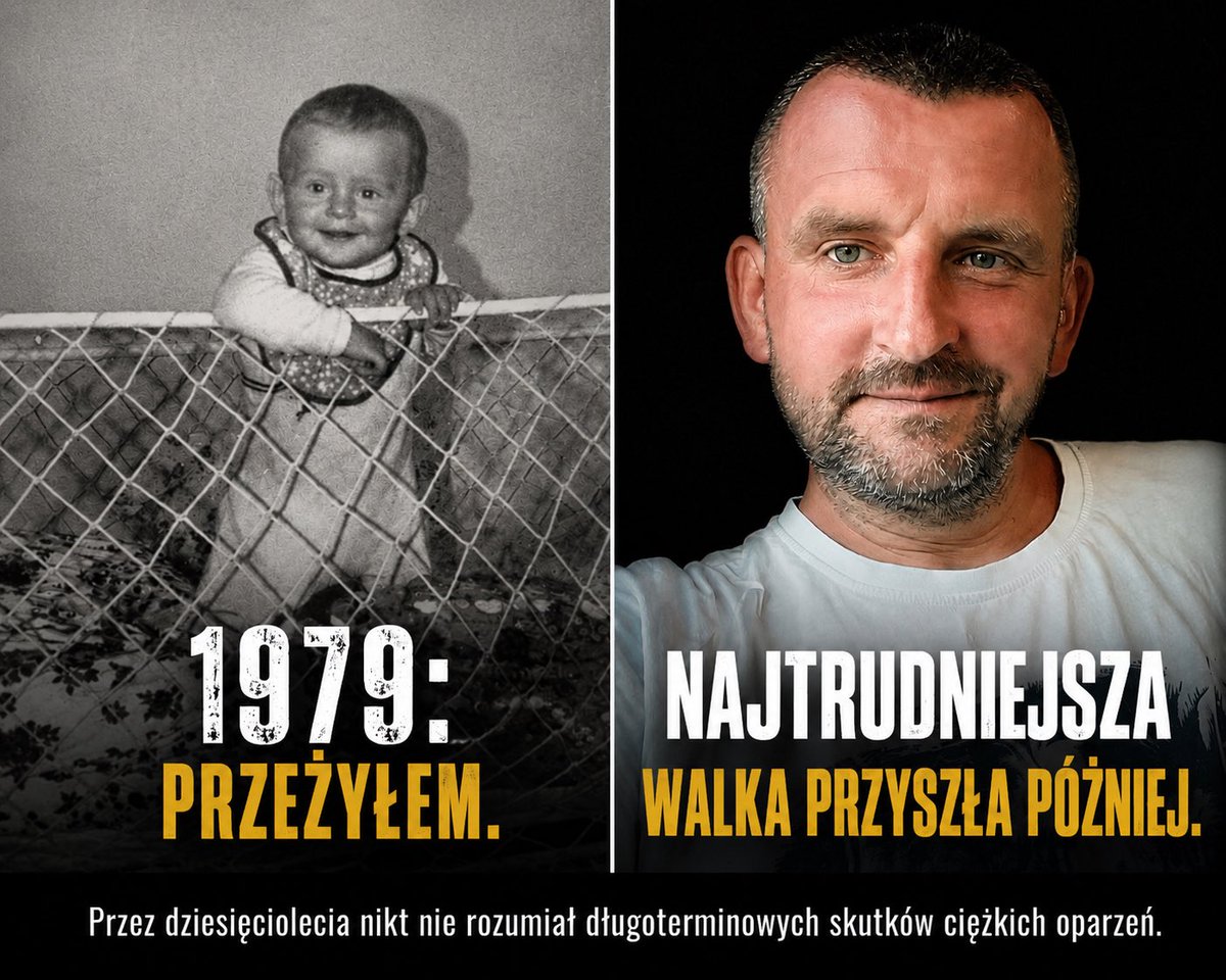 Summerholt1978's tweet photo. 💔 Być może największa krzywda nie wydarzyła się w 1979 roku.

Nie wtedy, gdy jako 13-miesięczne dziecko doznałem rozległych oparzeń III stopnia.

Być może wydarzyła się później.

W 1995 roku państwowa komisja oficjalnie potwierdziła, że moje inwalidztwo istnieje od 13. miesiąca życia.

Jednocześnie sprowadzono moją niepełnosprawność praktycznie wyłącznie do problemu słuchu.

A przecież już wtedy na moim ciele były rozległe blizny.

Już wtedy żyłem z następstwami ciężkiego oparzenia.

Już wtedy mój organizm był inny niż organizm zdrowego człowieka.

Przez następne lata kolejne instytucje patrzyły na mnie przez ten sam pryzmat.

Niedosłuch.

Tylko niedosłuch.

Tak jakby rozległe oparzenia III stopnia po prostu przestały istnieć.

Tak jakby uszkodzona skóra nie była narządem.

Tak jakby nie mogła powodować cierpienia, ograniczeń i problemów zdrowotnych.

Przez dziesięciolecia słyszałem, że przesadzam.

Że jestem przewrażliwiony.

Że problem może tkwić w psychice.

Dziś specjaliści opisują zaburzenia termoregulacji, przewlekły ból, uszkodzenia nerwów i wiele innych następstw ciężkich oparzeń.

Dziś medycyna mówi o rzeczach, które ja próbowałem tłumaczyć od lat.

I czasami zastanawiam się, jak wyglądałoby moje życie, gdyby ktoś potraktował mnie poważnie już wtedy.

Ile cierpienia można było uniknąć?

Ile lat walki z systemem nie musiałoby się wydarzyć?

Ile razy nie usłyszałbym, że problem jest w mojej głowie?

Bo kiedy system popełnia błąd wobec dziecka, konsekwencje tego błędu mogą ciągnąć się nie przez miesiące.

Ale przez całe życie.