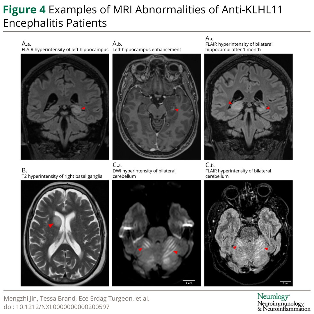 GreenJournal's tweet photo. Clinical Manifestations, Tumor Associations, and Long-Term Outcomes of Anti-KLHL11 Encephalitis: https://t.co/ZHsBXMKF0u https://t.co/Of2hTyECVN