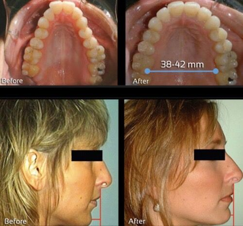 doctormorphh's tweet photo. Widening the maxilla is one of the best things you can do to become more attractive.

Habits, hormones, lifestyle, diet all play a role in the development of this bone. https://t.co/bNpIgKTRdo