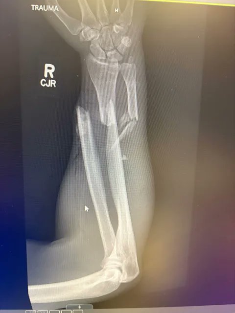 maxxhazard's tweet photo. Wow, look at the damage from one bite of a bear.
A Montana hiker surprised a grizzly bear that charged as soon as it saw him. 
The 32yo threw up his arms and the bear bit, dragged him about 20ft, then ran off. https://t.co/qjkbe0R1vA