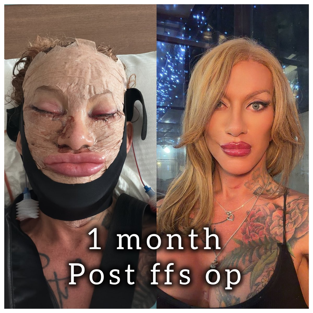 Shytransuk's tweet photo. Still lots of swelling to go down but I’m getting there 
#ffs #surgeryupdate #trans https://t.co/ILNzqbq88V