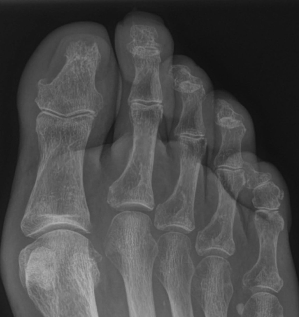 ETF_IRtrainees's tweet photo. #ClinicalCase
60-year-old diabetic patient with gangrene and osteomyelitis of the right foot distal 1st phalanx.
X ray of the right foot reveals erosive bone change in the distal 1st phalanx (fig 1).

🧵1/5 https://t.co/mK7l8HrV11