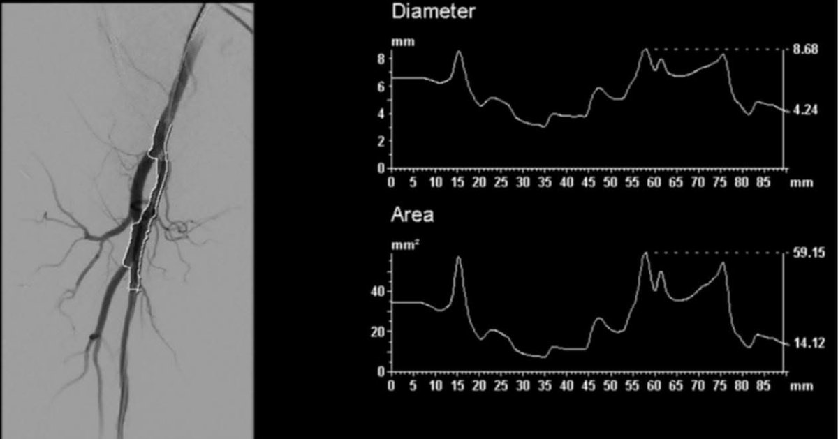ETF_IRtrainees's tweet photo. A new puncture is pursued more proximal in the CFA with repeat angiography and measurement for percutaneous transluminal angioplasty (PTA) planning (fig 5).

4/5 https://t.co/osSc5YD25f
