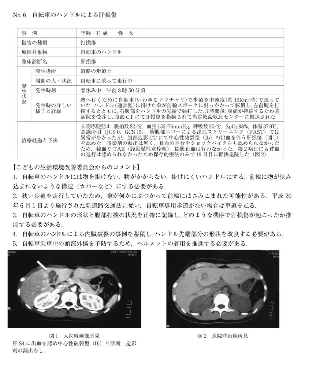 AoringoDr's tweet photo. 🚨【絶対やめて】自転車のハンドルに傘をかけると、子どもの「肝臓」が破裂する恐れがあります。

日本小児科学会の傷害速報（Injury Alert No.6）でも警告されている、一歩間違えれば命に関わる実際の事例です。

■ 実際に起きた事故（11歳女の子）
ハンドルにかけていた傘が前輪に巻き込まれ、自転車が急停止して転倒。

その反動でハンドルの先端がお腹に強く突き刺さり、「肝臓」を損傷（肝破裂）して救急搬送されました。
（※約3週間の入院で無事に退院できましたが、危険な状態でした）

⚠️ なぜ重症化するの？
ハンドルの先端は細いため、転倒時の体重とスピードのエネルギーが「お腹の一点」に集中します。子どもの柔らかい内臓にとっては、一瞬で凶器に変わってしまいます。

🍎今日から徹底してほしい3つの対策
①ハンドルには「絶対に」物をかけない
（荷物は必ずカゴに入れるか、リュック等で背負う！）
②グリップの端をチェックする
（ゴムが破れて金属が剥き出しになっていると破壊力が倍増します。すぐに交換を！）
③必ずヘルメットを着用する
（急転倒時の頭部を守るために必須です）

ちょっとした「まあいっか」の油断が、子どもを危険に晒してしまいます。

痛ましい事故を一件でも減らすため、ぜひ周りのパパママにも「リポスト」で教えてあげてください！