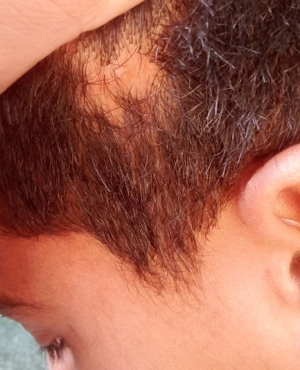 RozeatG's tweet photo. Don't ignore me, please 😭😭🙏
My son's hair is falling out profusely. A bacterial infection has spread due to contaminated water and a lack of cleaning supplies. Please help us. Donate so we can buy the necessary treatment and cleaning supplies. Please

https://t.co/PoTNVpFiJv https://t.co/WO8jYj42lU