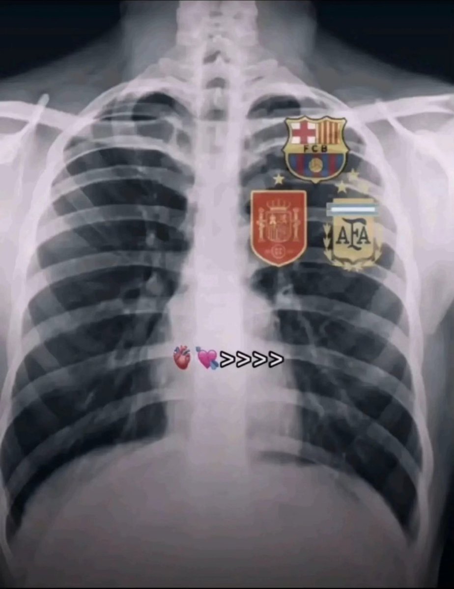 MVO_KING's tweet photo. Went for a chest X-ray today.

Doctor: Any history of football obsession in your family?

Me: Not that I know of.

Doctor looks at the scan.

Doctor: Yeah... it's hereditary now. 💀❤️💙🇪🇸🇦🇷 https://t.co/nKebnFIS89