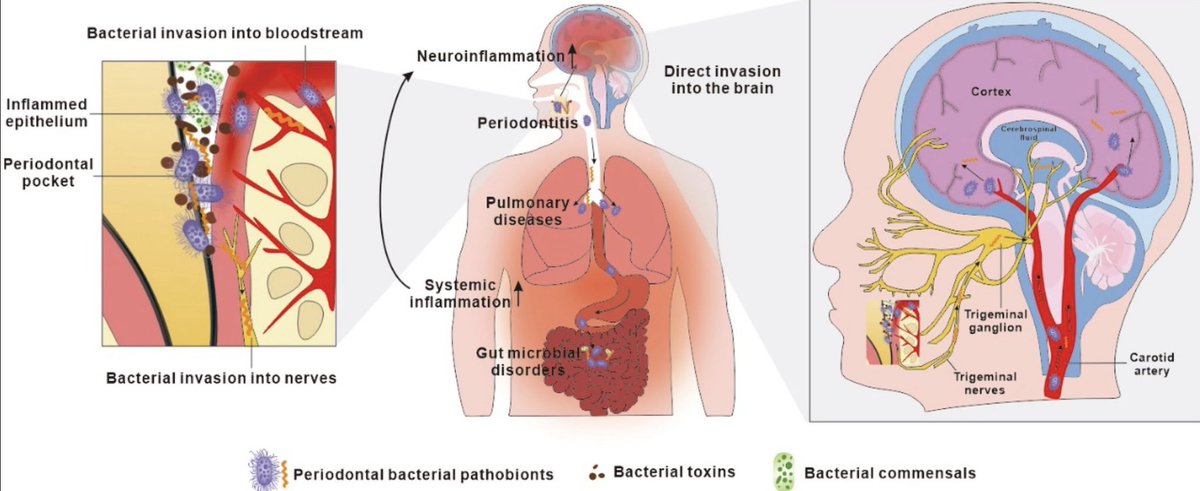 DrGrahamLJ's tweet photo. A primer on how gum disease bacteria cause* Alzheimer’s.

(*No, it is not just correlation!)

Porphyromonas gingivalis and the pathogenesis of Alzheimer’s disease
Liu et al 2022
👇👇👇
https://t.co/lCzuzoAUY5 https://t.co/BMoNV5mygg