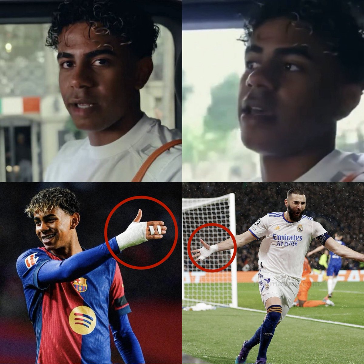 futbolnamass's tweet photo. ⚽🤕✋ 𝗟𝗔𝗠𝗜𝗡𝗘 𝗬𝗔𝗠𝗔𝗟 𝗥𝗘𝗩𝗘𝗟𝗔 𝗤𝗨𝗘 𝗦𝗘 𝗜𝗡𝗦𝗣𝗜𝗥𝗢́ 𝗘𝗡 𝗕𝗘𝗡𝗭𝗘𝗠𝗔 𝗣𝗔𝗥𝗔 𝗦𝗨 𝗩𝗘𝗡𝗗𝗔𝗝𝗘

🗣️ Lamine Yamal explicó el curioso origen del vendaje que suele usar en una de sus manos.

🎮 “Jugando a la Play le di un golpe a la televisión y me lastimé los dedos. Se me hincharon bastante, así que me vendé la mano.”

😂 “Luego hicimos la broma de KB9, KB9, porque parecía el vendaje de Karim Benzema. Me gustó cómo se veía y decidí seguir usándolo.”

🤍 Al parecer, el joven crack español terminó adoptando un detalle que hizo famoso Karim Benzema durante gran parte de su carrera.

⸻

⚽🤕✋ 𝗟𝗔𝗠𝗜𝗡𝗘 𝗬𝗔𝗠𝗔𝗟 𝗥𝗘𝗩𝗘𝗔𝗟𝗦 𝗛𝗘 𝗧𝗢𝗢𝗞 𝗜𝗡𝗦𝗣𝗜𝗥𝗔𝗧𝗜𝗢𝗡 𝗙𝗥𝗢𝗠 𝗕𝗘𝗡𝗭𝗘𝗠𝗔’𝗦 𝗕𝗔𝗡𝗗𝗔𝗚𝗘

🗣️ Lamine Yamal has revealed the story behind the hand bandage he often wears.

🎮 “I hit the TV while playing PlayStation and hurt my fingers. They swelled up a lot, so I wrapped my hand.”

😂 “Then we started joking about KB9 because it looked like Karim Benzema’s bandage. I liked how it looked and decided to keep wearing it.”

🤍 It turns out the young Spanish star ended up adopting a look made iconic by Karim Benzema throughout his career.

#lamineyamal #benzema #football #futbolnamass