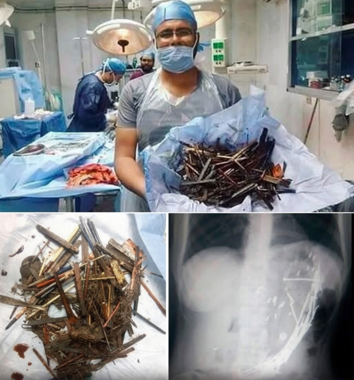 porqueTTarg's tweet photo. "Desquiciada"

Porque una mujer de 43 años llegó al hospital sufriendo de dolor abdominal severo, vómitos persistentes y problemas digestivos que empeoraban y que habían durado aproximadamente diez días.  

Las imágenes revelaron un bezoar metálico masivo, una gran masa endurecida de material no digerible, que llenaba completamente su estómago. 

Durante la cirugía de emergencia, los médicos extrajeron una sorprendente colección de objetos, incluyendo clavos, bolígrafos, una cuchara, trozos de madera, una cadena metálica, un cepillo de dientes, cabello y otros artículos variados que se habían acumulado durante meses.

La mujer contó que consumió objetos metálicos durante varios meses, creyendo que eso ayudaría a tratar una condición subyacente. La acumulación eventualmente causó una obstrucción severa que requirió una intervención quirúrgica urgente.