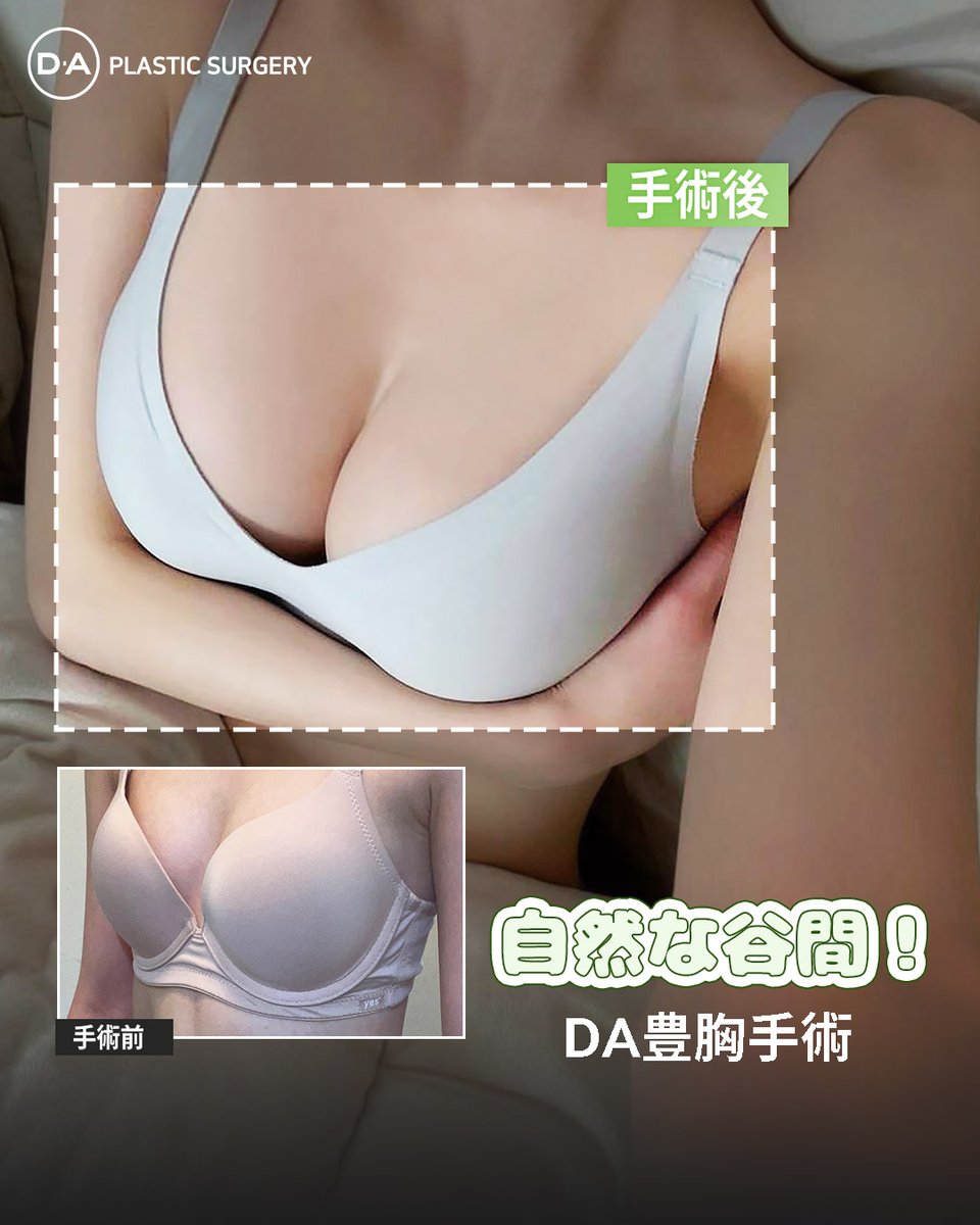 daprsjp's tweet photo. 🩵🌴【綺麗になりたいなら？DA美容外科】🌴🩵

DA✨安全安心✨豊胸

DAだけの特別なシリコン豊胸👙✨

#モティバ
#メンター
#メンターエクストラ
#メンターブースト
#メンタースムース

🔽公式ライン🔽➡https://t.co/SM8bYFdPCM https://t.co/6cqVUyQpKV