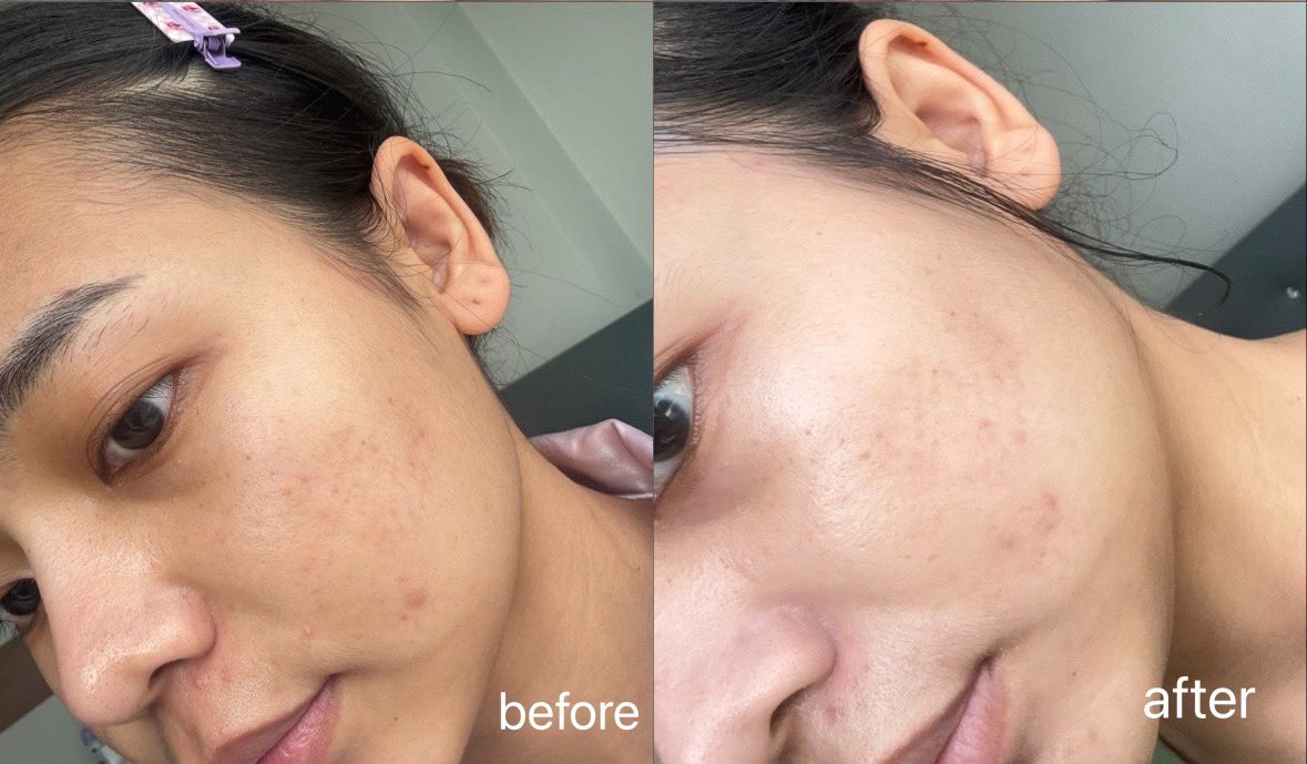 ggiiing's tweet photo. ว้าวไม่ไหว…🥹✨Hadalabo PREMIUM WHITENING ใช้มา 1 เดือน รู้สึกเลยว่าผิวดูไบรท์ขึ้นแบบเห็นได้ชัด! 

#ฮาดะลาโบะ #น้ำตบผิวดื่มแสง https://t.co/kDjFNSAnO2