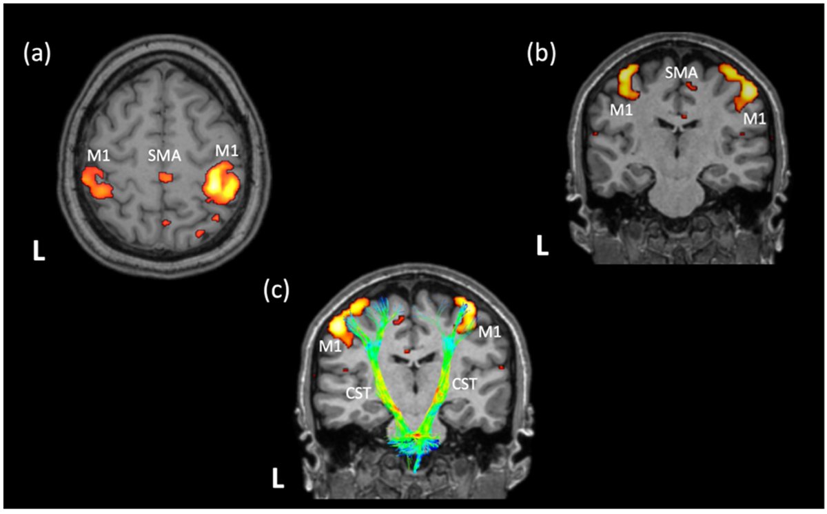 neurolint_mdpi's tweet photo. 🌟Welcome to read the Review:

A Comprehensive  Review on the Role of Resting-State Functional Magnetic Resonance  Imaging in Predicting Post-#Stroke Motor and Sensory Outcomes by Foteini Christidi et al.

Full-text Available: https://t.co/ClzUUK9Ozg

#fMRI #stroke #motor #RSfMRI https://t.co/gSMHFIPzgE