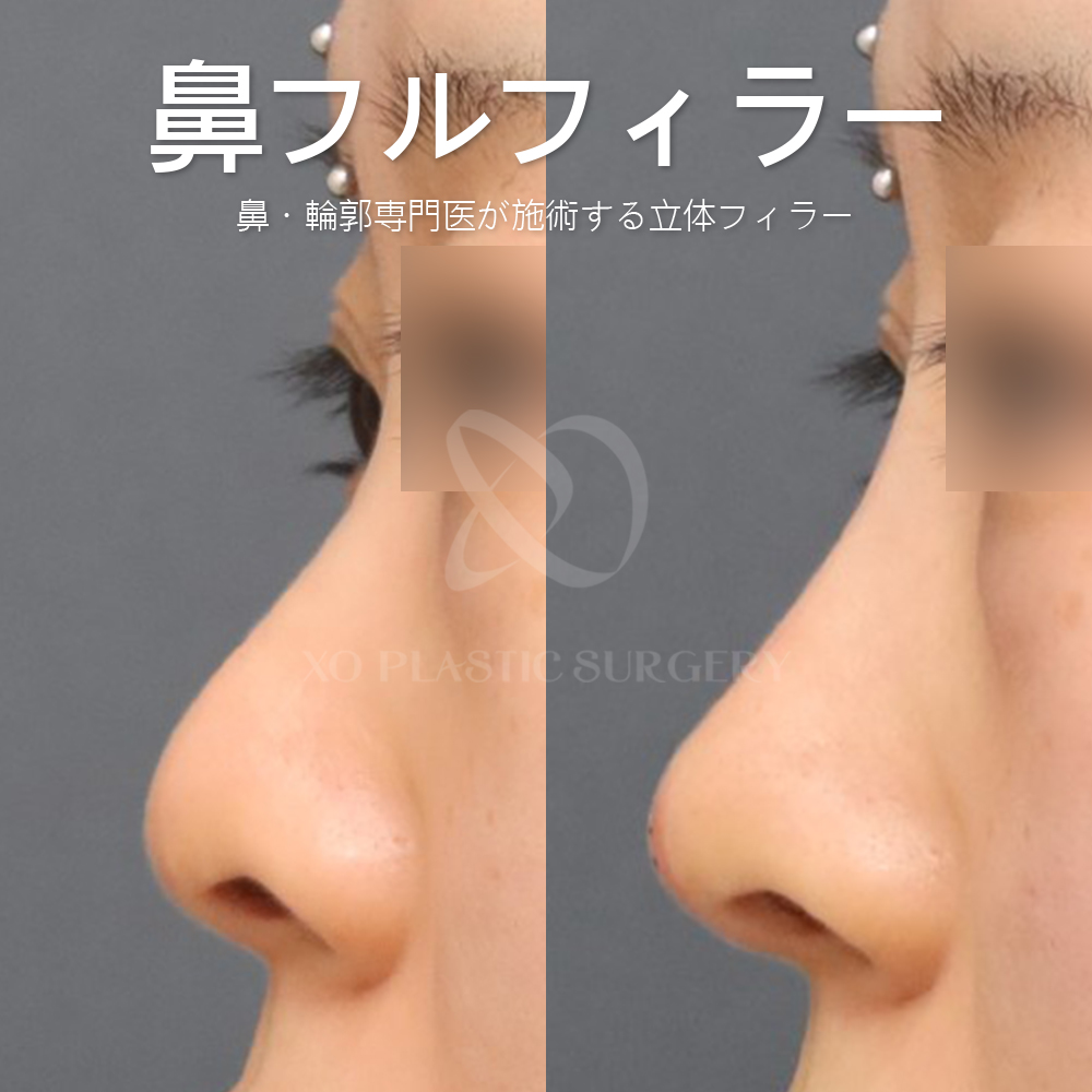 xops_jp's tweet photo. 【 XO 鼻フルフィラー👃🏻✨】
鼻筋から鼻先まで理想的な形に！

高額な手術❌
手軽な施術⭕️

長いダウンタイム🙅🏻‍♀️
短いダウンタイム🙆🏻‍♀️

📢6~7月中施術の場合モニター
特別割引価格でのご案内です❤️‍🔥

公式LINEへお問い合わせください
📩https://t.co/9QOhaH2sfd

#鼻ヒアル #ヒアルロン酸 #プチ整形 https://t.co/lmbaCIwFt4