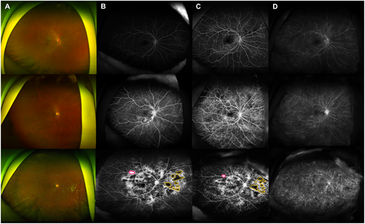 ARVOtvst's tweet photo. Jiwon Baek et al. from The Catholic University of Korea assess deep learning-generated ultra-widefield fluorescein angiography from fundus images in diabetic retinopathy. 
https://t.co/10ZaV8pVKz https://t.co/f9wqUXXYM9