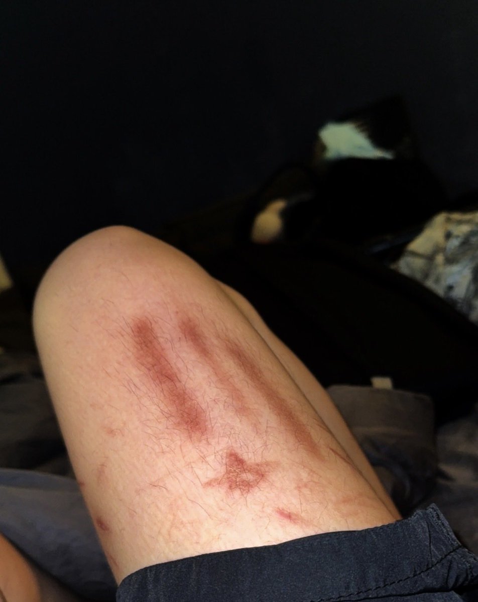 NVRN0AH's tweet photo. I love these scars https://t.co/gQziZvWwpO