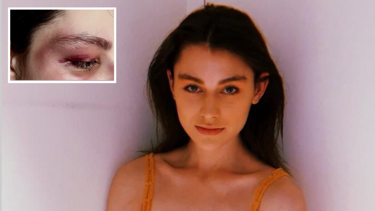 CerfiaFR's tweet photo. 🇮🇹🇵🇱 FLASH | La mannequin polonaise Anna Aksamit affirme avoir été AGRESSÉE à Milan par un groupe de 7 à 8 jeunes hommes alcoolisés.

Frappée à plusieurs reprises à la tête, elle dit avoir échappé à une agression sexuelle grâce à l'intervention d'un jeune Italien qui serait venu à son secours avant de quitter les lieux sans révéler son identité.

La jeune femme lance aujourd'hui un appel pour retrouver celui qu'elle considère comme son sauveur et le remercier pour son courage.