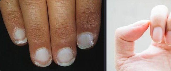 mwenangbejok's tweet photo. ❣️ intermezzo❣️
KUKU PUCAT ATAU PUTIH

Kuku pucat atau putih bisa menjadi tanda adanya masalah kesehatan di dalam tubuh, mulai dari kekurangan nutrisi hingga gangguan organ vital. Kuku yang normal dan sehat umumnya berwarna merah muda cerah merata karena aliran darah yang lancar di bawahnya.
Berikut adalah beberapa penyebab utama mengapa kuku Anda bisa berubah menjadi pucat atau putih:
🤍Anemia Defisiensi Besi:
Ini adalah penyebab paling umum. Rendahnya hemoglobin membuat darah kekurangan oksigen, sehingga dasar kuku kehilangan warna merah muda alaminya.
🤍Malnutrisi: Kekurangan zat gizi penting seperti zat besi, vitamin B12, atau asam folat dapat menghambat produksi sel darah merah.
🤍Gangguan Sirkulasi Darah: 
Kondisi medis yang menghambat aliran darah ke ujung jari membuat kuku tampak memucat. Efek ini biasanya memburuk saat cuaca dingin.
🤍Penyakit Hati (Liver): 
Kondisi seperti sirosis hati bisa memicu Terry's nails, yaitu kondisi di mana hampir seluruh kuku berwarna putih dengan pita merah muda di ujungnya.
🤍Penyakit Ginjal atau Jantung: Ketidakmampuan jantung memompa darah dengan baik atau gangguan fungsi ginjal dapat memengaruhi pasokan oksigen dan warna jaringan kuku.
🤍Trauma atau Cedera (Leukonychia): 
Bintik atau garis putih pada kuku seringkali dipicu oleh cedera ringan, seperti kuku yang terbentur, terjepit, atau efek samping perawatan manicure.

Gejala Lain yang Perlu Diwaspadai
Perhatikan apakah kuku pucat Anda disertai gejala tubuh lainnya, seperti:
🤍Rasa lemas, lesu, dan mudah lelah, Pusing, sakit kepala, atau sering merasa ingin pingsan, Sesak napas, terutama saat beraktivitas ringan.
🤍Kuku bertekstur rapuh, berlapis, atau mudah patahKulit atau bagian putih mata menguning (jaundice).

Kapan Harus ke Dokter ?
Jika perubahan warna kuku terjadi secara tiba-tiba, berlangsung lama, atau disertai dengan sesak napas, nyeri dada, kelelahan ekstrem, dan pusing hebat, segera lakukan pemeriksaan medis ke fasilitas kesehatan terdekat. Anda juga bisa berkonsultasi secara daring melalui platform kesehatan tepercaya seperti Halodoc atau Alodokter untuk mendapatkan diagnosis awal yang tepat.

꧁Büllöck꧂
dari berbagai sumber