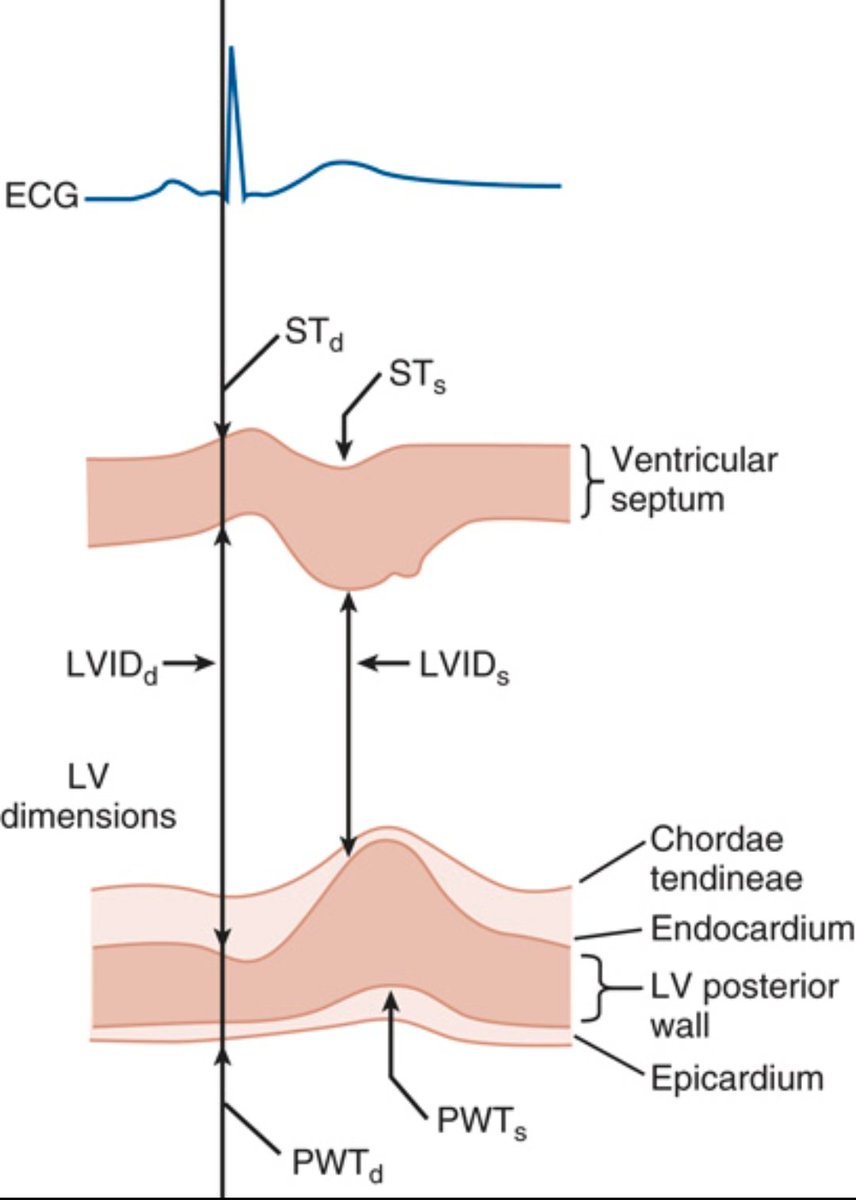 TrackYourHeart's tweet photo. M-Mode Echo: A Window into LV Function
This schematic illustrates how 2D-guided M-mode echocardiography measures left ventricular (LV) wall thickness and chamber dimensions throughout the cardiac cycle.

Timing of Measurements:
- Diastole: Measured at the Q wave of the ECG
- Systole: At max posterior septal motion, when motion is normal

Key Parameters:
- LVIDd = LV internal diameter in diastole
- LVIDs = LV internal diameter in systole
- STd/STs = Septal thickness (diastole/systole)
- PWTd/PWTs = Posterior wall thickness (diastole/systole)

What is Fractional Shortening (FS)?
Fractional shortening (FS) is the percentage change in LV internal diameter from diastole to systole.
Formula
FS (%) = [(LVIDd − LVIDs) ÷ LVIDd] × 100
Normal range: 25–45%

Clinical Significance:
- Reduced FS% suggests impaired LV systolic function (e.g., in heart failure or cardiomyopathy)
- Increased wall thickness may point to LV hypertrophy (e.g., due to hypertension or aortic stenosis)
- Rapid and reproducible, ideal for screening and serial assessments

Source: Aurigemma GP et al., Curr Probl Cardiol. 1995;20:381.
