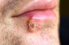 stoicmen_'s tweet photo. STIs that can be passed on from oral sex include:

1. Chlamydia 

2. Gonorrhoea 

3. Syphilis 

4. Herpes 

5. Human Papillomavirus 

6. HIV 

7. Trichomoniasis https://t.co/YxTfCDQUTo