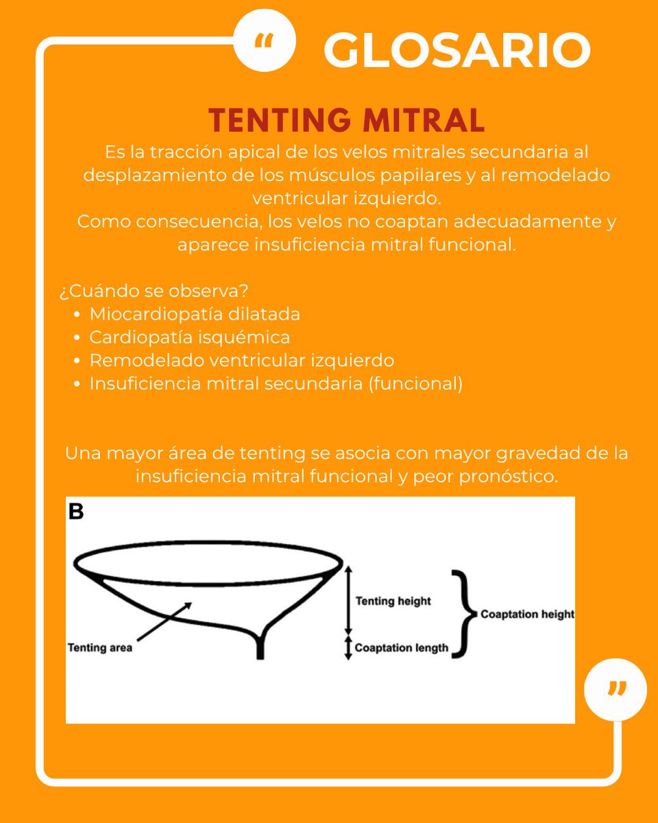 SONECOM_AC's tweet photo. El tenting mitral es la tracción apical de los velos mitrales secundaria al desplazamiento de los músculos papilares y al remodelado del ventrículo izquierdo.
🫀 Como resultado, los velos no coaptan adecuadamente y aparece insuficiencia mitral funcional.
#SONECOM #GlosarioSONECOM https://t.co/4JpHbUDMit