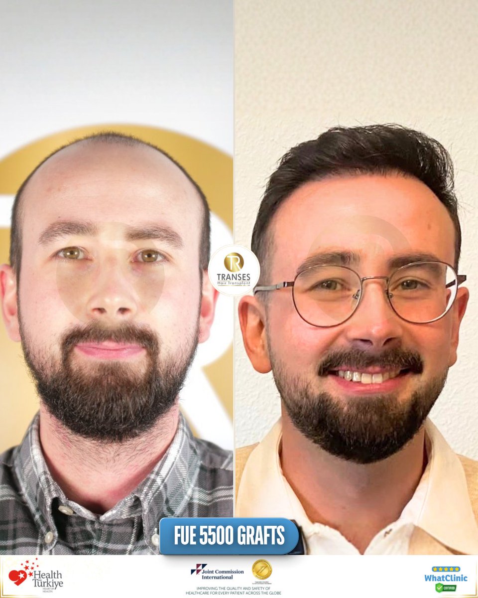 transeshair's tweet photo. This hair transplant operation was performed at Istanbul Tema Hospital BHT Clinic.
15 years of experience with a 4.9 ⭐ WhatClinic rating.
FUE • DHI • HYBRID • PRP
Natural results, professional care.

#YourJourneyYourTransformation
#TransesHairTransplant
#FUE #DHI #PRP https://t.co/ED4ToYTlVn