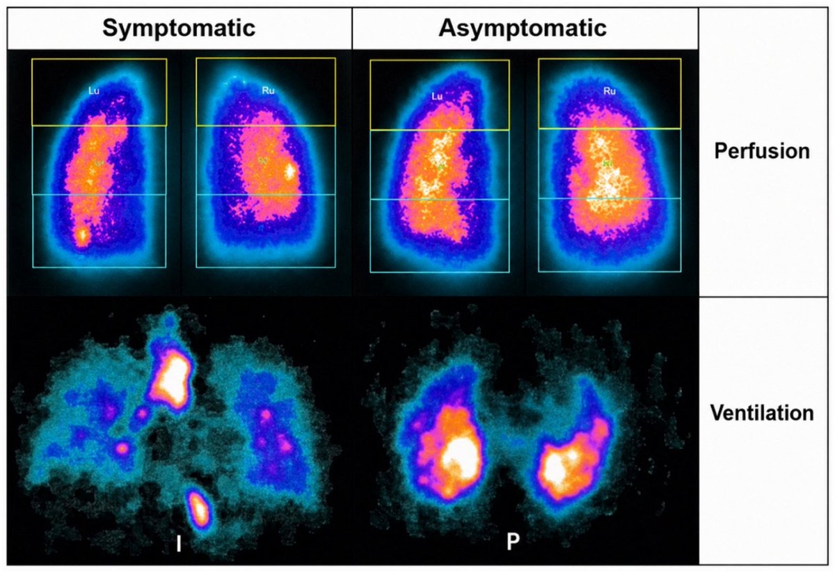 vipintukur's tweet photo. #LongCOVID may be affecting far more than the lungs alone.

➡️ Researchers found that symptomatic post-COVID patients had weaker inspiratory muscles, abnormal lung ventilation/perfusion patterns on scintigraphy, and significantly poorer sleep quality.

➡️ The most striking finding? Inspiratory muscle endurance was strongly linked to how well air reached the lungs (r = 0.93) and was closely associated with daytime sleepiness and sleep disruption. 1/