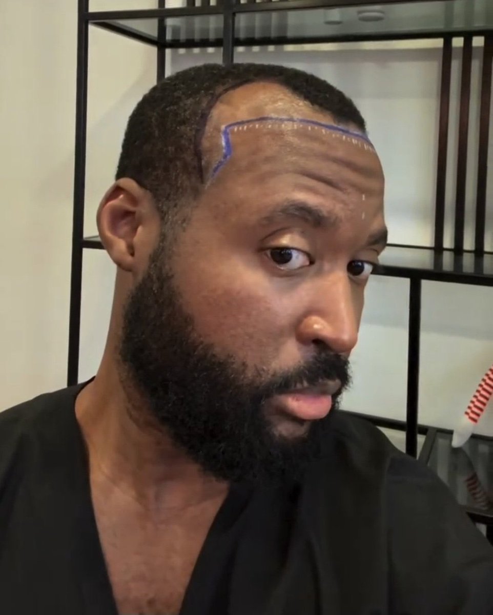 Bigdraxxx7's tweet photo. Man shows insane transformation after receding hairline surgery https://t.co/j8LXN3dRow